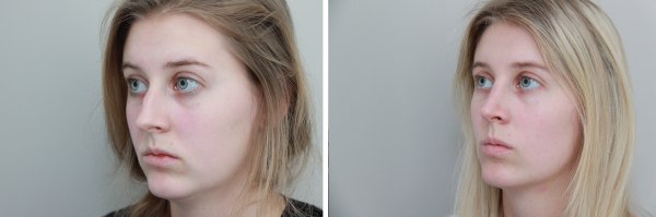 Rhinoplasty Before & After Photo 101