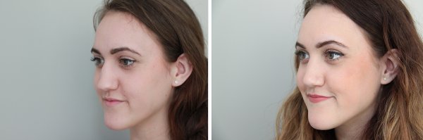 Rhinoplasty Before & After Photo 115