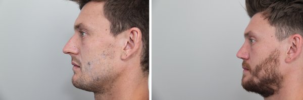 Male Rhinoplasty Before & After Photo 120