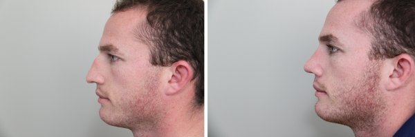 Male Rhinoplasty Before & After Photo 123