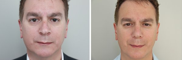 Male Rhinoplasty Before & After Photo 126