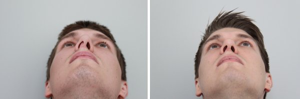 Male Rhinoplasty Before & After Photo 130