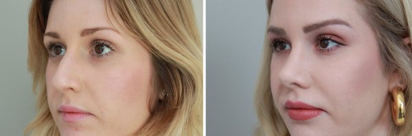 Rhinoplasty Before & After Photo 147