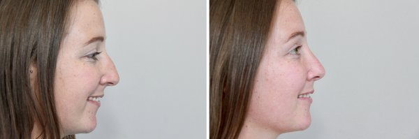 Rhinoplasty Before & After Photo 151