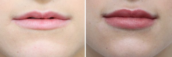Cheek & Lip Augmentation Before & After Photo 49