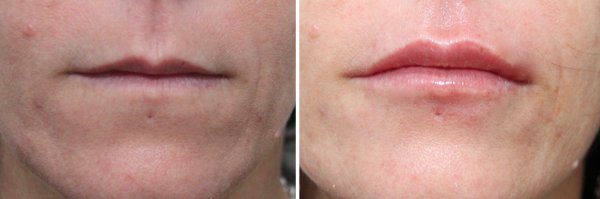 Cheek & Lip Augmentation Before & After Photo 50