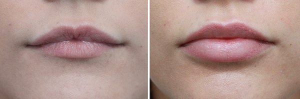 Cheek & Lip Augmentation Before & After Photo 51