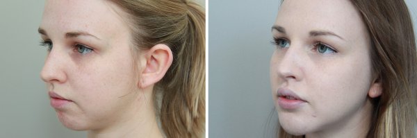 Cheek & Lip Augmentation Before & After Photo 52