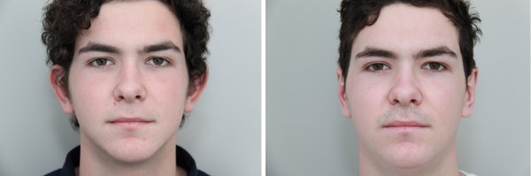 Otoplasty Before & After Photo 65