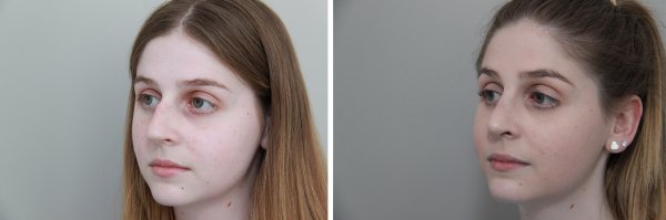 Rhinoplasty Before & After Photo 77
