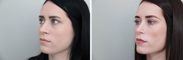 Rhinoplasty Before & After Photo 80