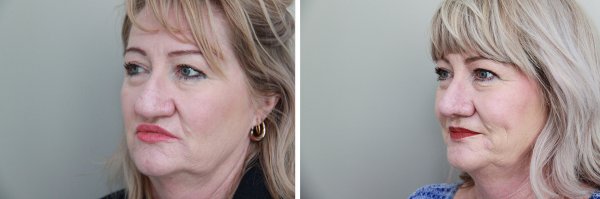 Rhinoplasty Before & After Photo 105