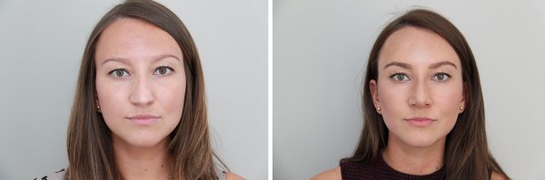 Rhinoplasty Before & After Photo 111