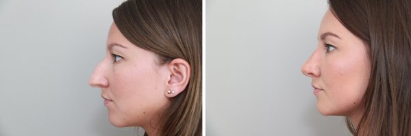Rhinoplasty Before & After Photo 112