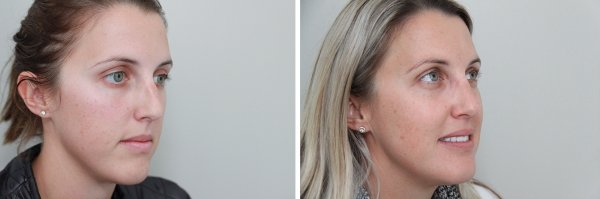 Rhinoplasty Before & After Photo 116