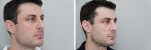 Male Rhinoplasty Before & After Photo 118