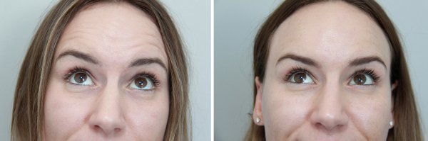 Wrinkle Relaxers Before & After Photo 154