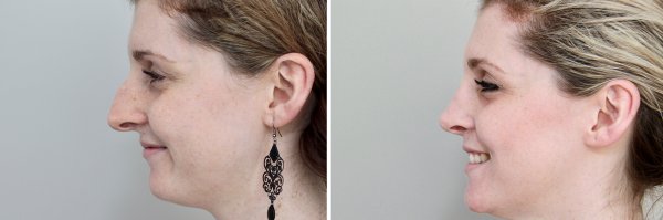 Rhinoplasty Before & After Photo 155
