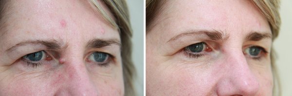 Mole Removal Before & After Photo 53