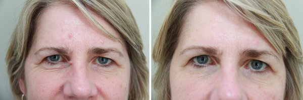 Mole Removal Before & After Photo 54