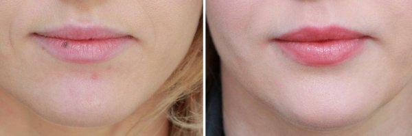 Mole Removal Before & After Photo 55