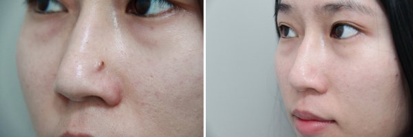 Mole Removal Before & After Photo 56