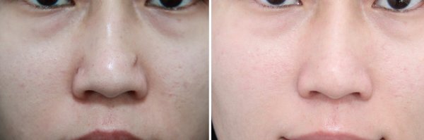 Mole Removal Before & After Photo 57