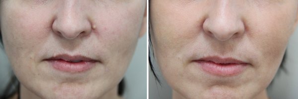 Mole Removal Before & After Photo 58