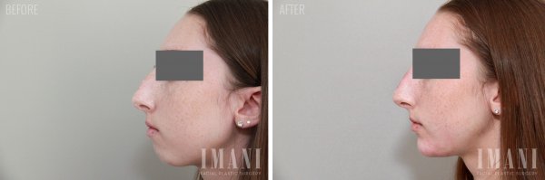 Non Surgical Rhinoplasty Before & Photo 60