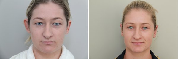 Otoplasty Before & After Photo 63