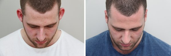Otoplasty Before & After Photo 67