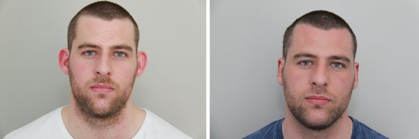 Otoplasty Before & After Photo 68