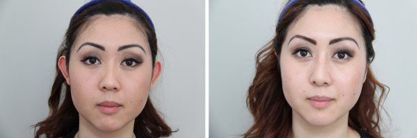 Otoplasty Before & After Photo 70