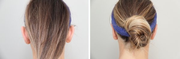 Otoplasty Before & After Photo 71