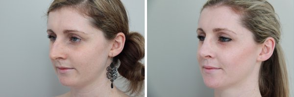 Rhinoplasty Before & After Photo 74