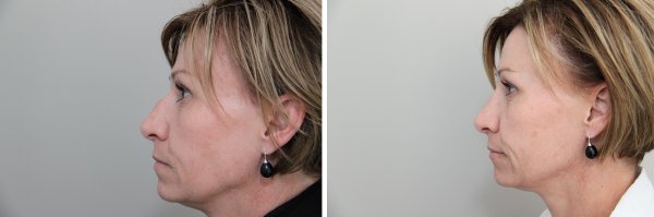 Rhinoplasty Before & After Photo 87
