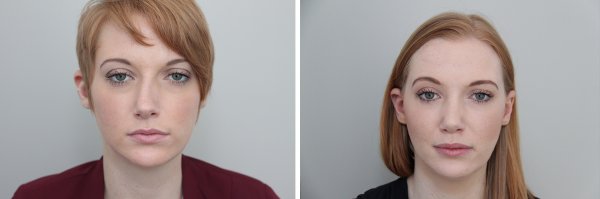 Rhinoplasty Before & After Photo 94