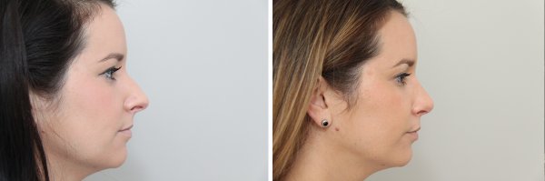 Rhinoplasty Before & After Photo 98