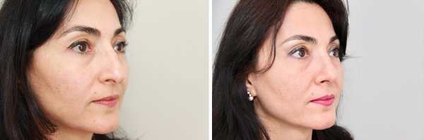 Rhinoplasty Before & After Photo 100
