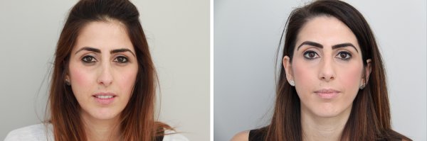 Rhinoplasty Before & After Photo 102