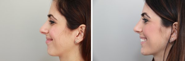 Rhinoplasty Before & After Photo 103