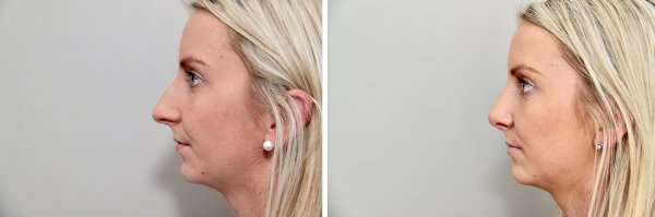 Rhinoplasty Before & After Photo 104