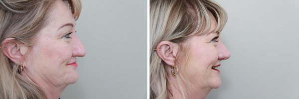 Rhinoplasty Before & After Photo 106