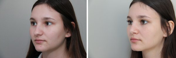Rhinoplasty Before & After Photo 107