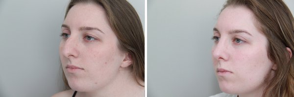 Rhinoplasty Before & After Photo 108