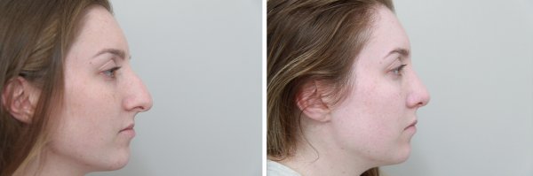 Rhinoplasty Before & After Photo 109