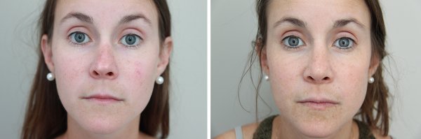 Rhinoplasty Before & After Photo 110
