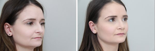 Rhinoplasty Before & After Photo 113