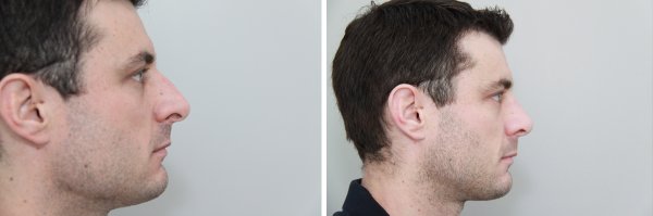 Male Rhinoplasty Before & After Photo 117