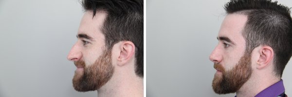 Male Rhinoplasty Before & After Photo 119